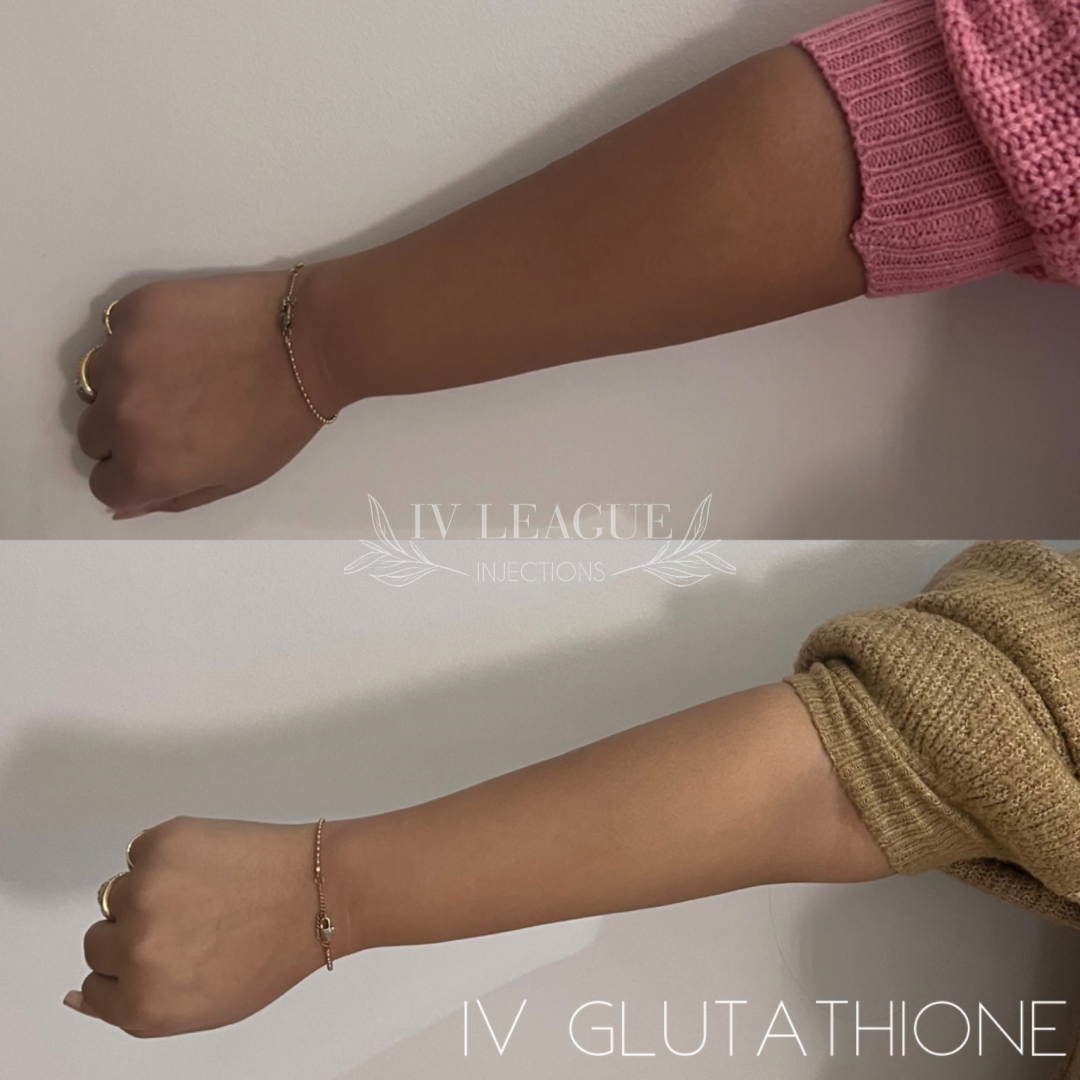 Glutathione IV therapy in Vancouver for skin brightening and antioxidant detox with IV League Injections at Six Clinic
