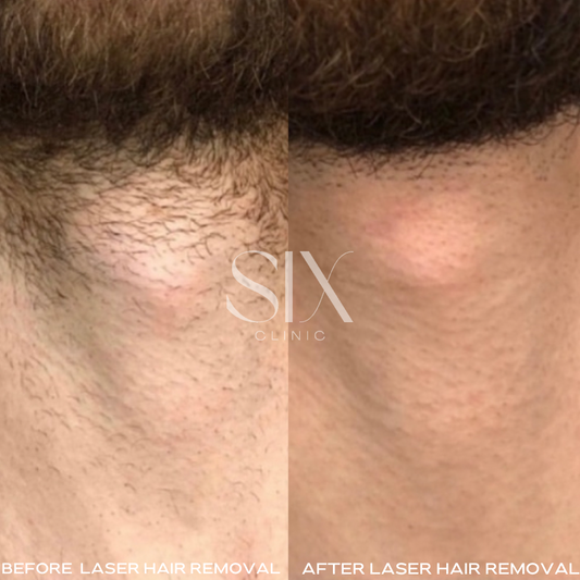 Laser Hair Removal for Men in Vancouver
