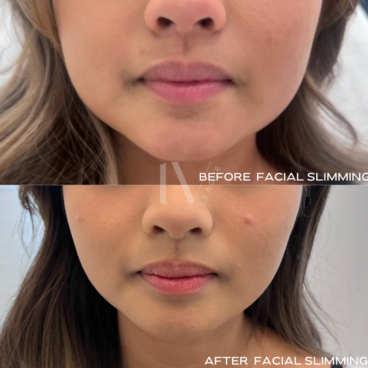 Masseter Botox Vancouver: Jaw Slimming & Jaw Tension Relief