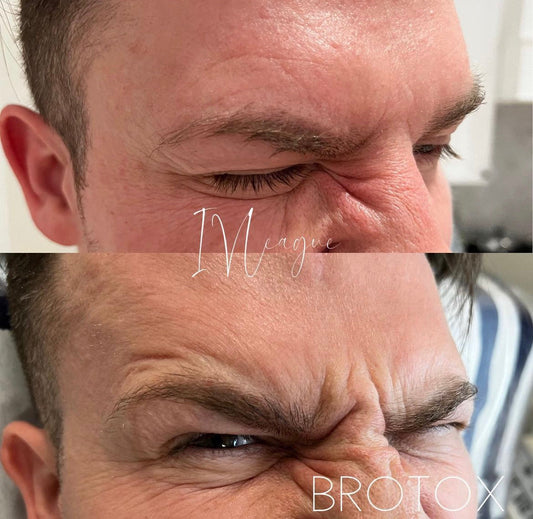 Why Men Need More Botox (And Why It Doesn’t Look Frozen)
