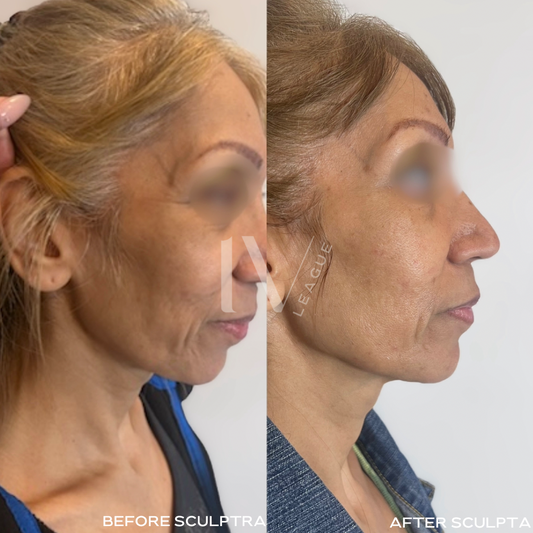 Sculptra vs Radiesse Vancouver: Biostimulator Guide