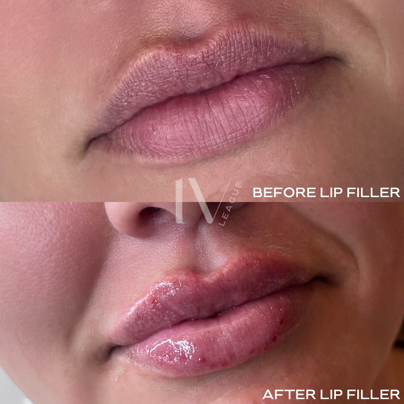 hydrated lip filler vancouver lip injections six clinic