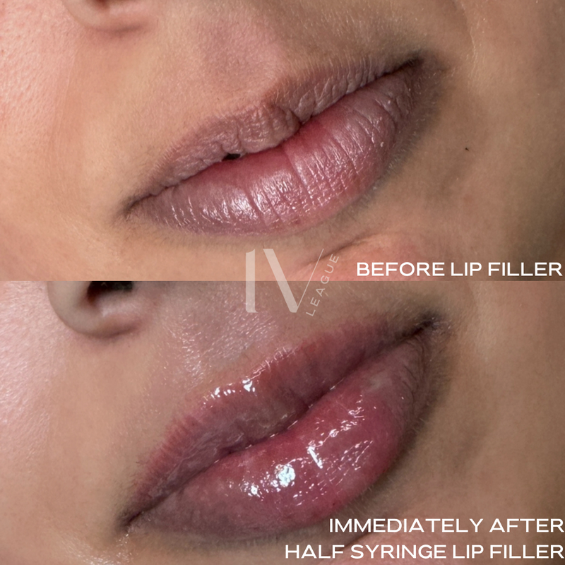 natural lip filler enhancement vancouver lip injections six clinic