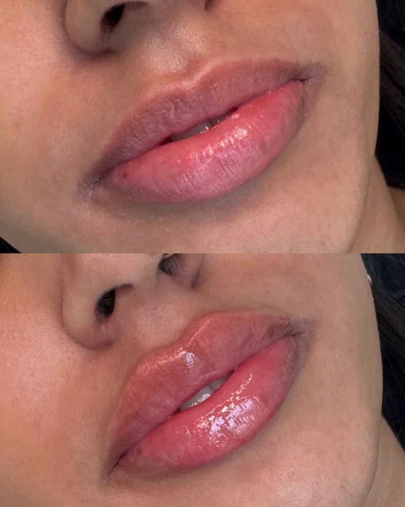 lip filler volume vancouver lip injections six clinic