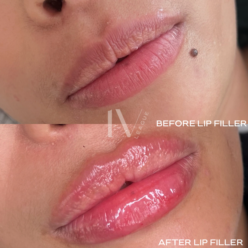 custom lip filler treatment vancouver six clinic injector