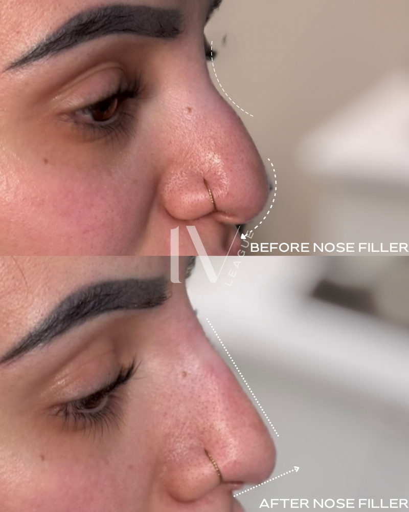 Hyaluronic acid nose filler smoothing dorsal hump Vancouver clinic