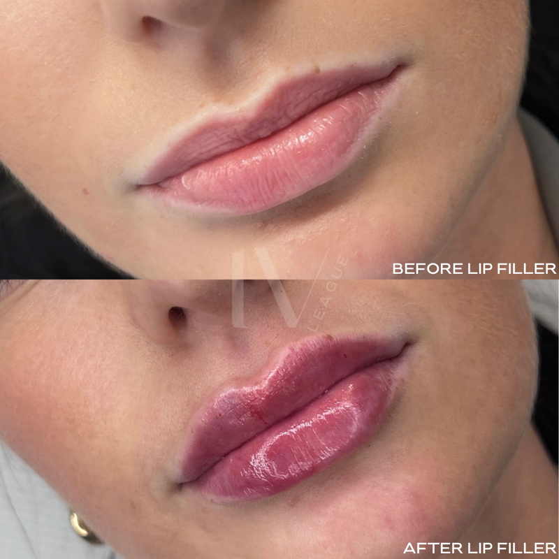 lip filler definition vancouver cosmetic injector six clinic