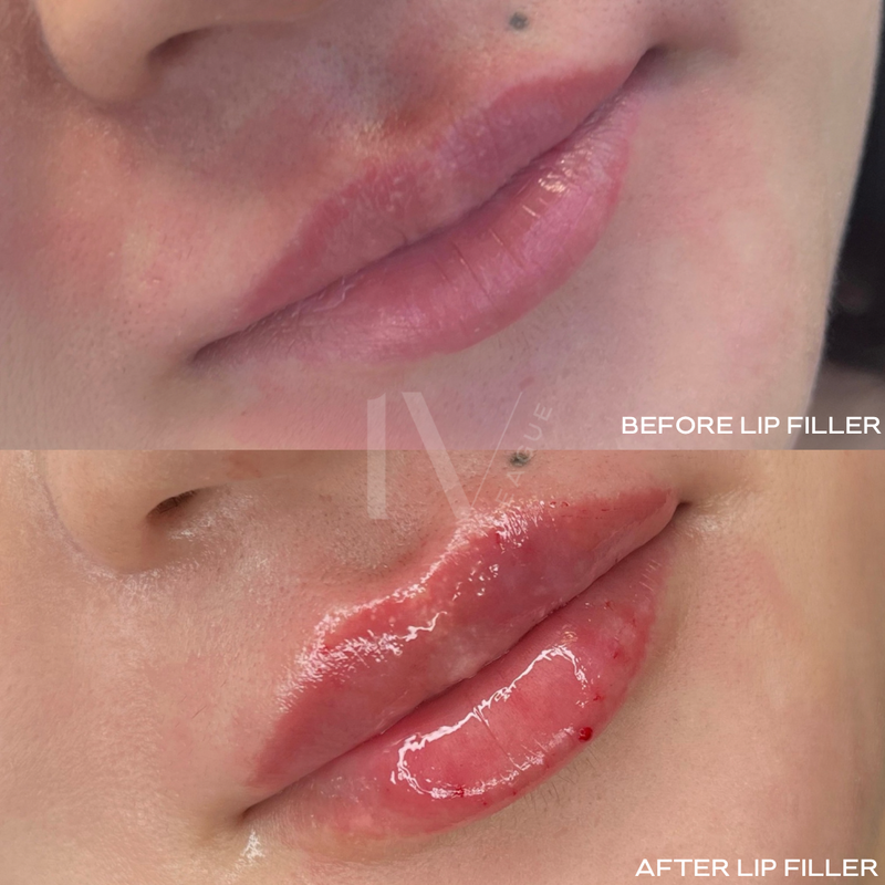 lip filler vancouver natural lips dermal filler six clinic
