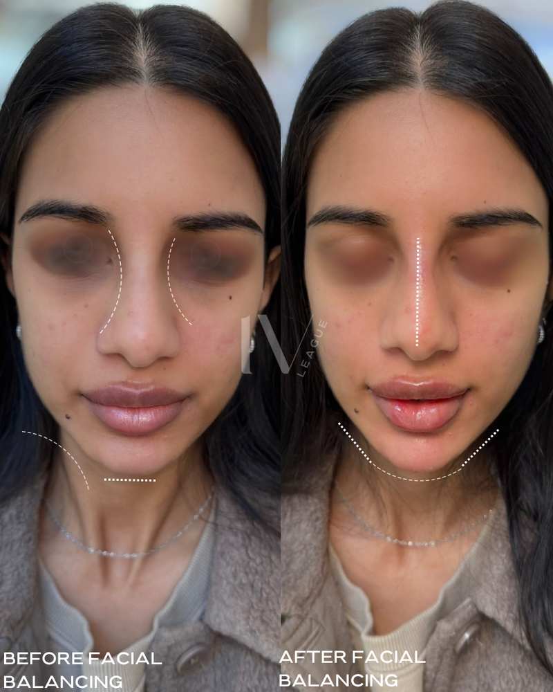 Hyaluronic acid nose filler smoothing dorsal hump Vancouver clinic