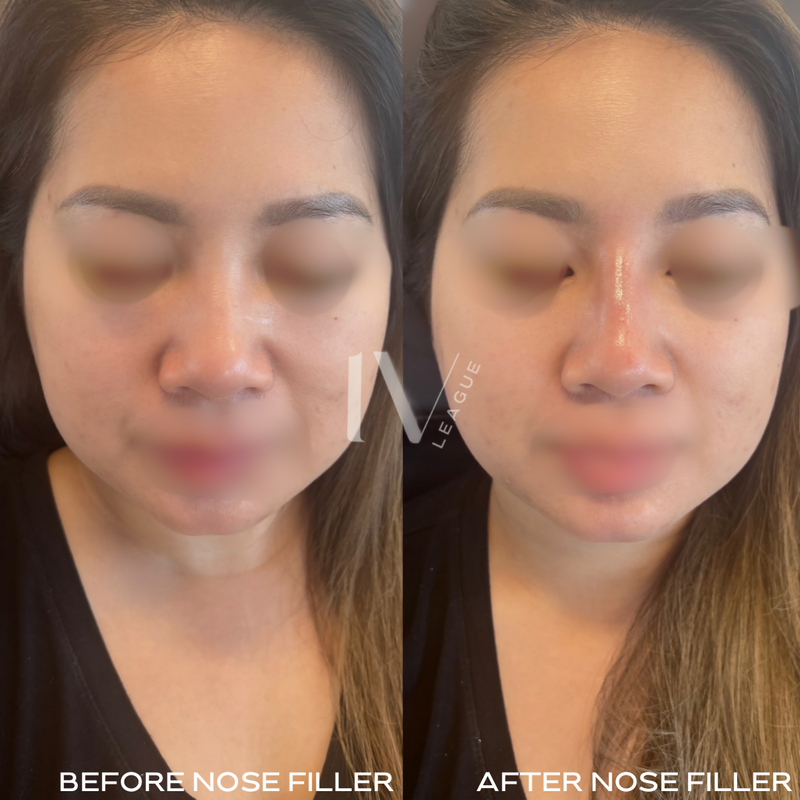 Nose filler procedure Vancouver cosmetic injector Vicki Nguyen RN