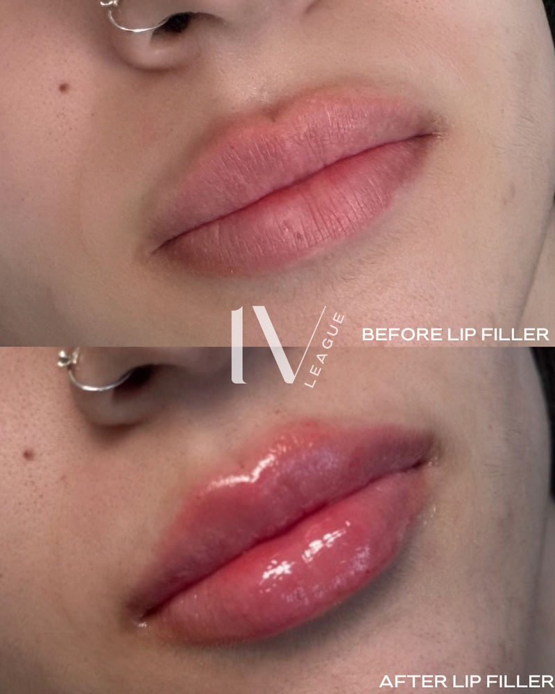 lip filler symmetry enhancement vancouver dermal filler lips