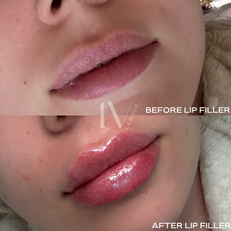lip filler natural shape vancouver six clinic injector