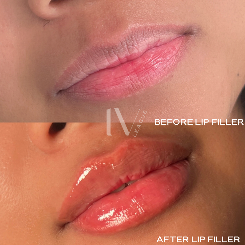 ip filler proportions vancouver dermal filler lips
