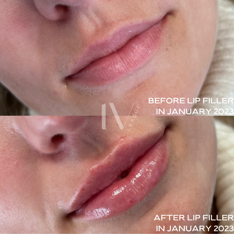 lip filler before after vancouver cosmetic injector six clinic