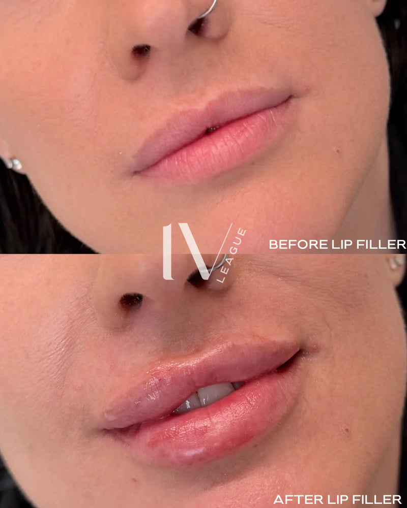 natural lip filler movement vancouver dermal filler