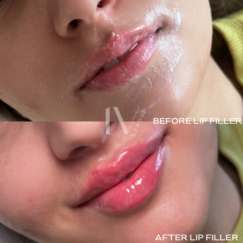 lip filler definition vancouver dermal filler lips six clinic