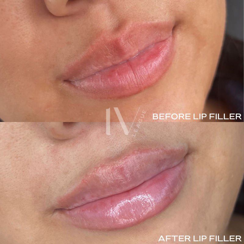 lip filler facial harmony vancouver dermal filler lips