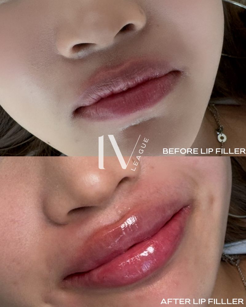 lip filler vancouver natural beauty dermal filler six clinic