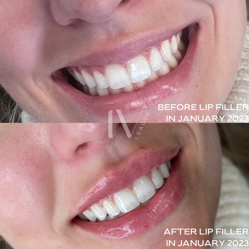 custom lip filler vancouver cosmetic injector six clinic