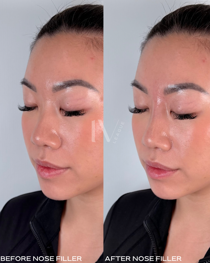 Non surgical nose job Vancouver performed by experienced injector Vicki Nguyen