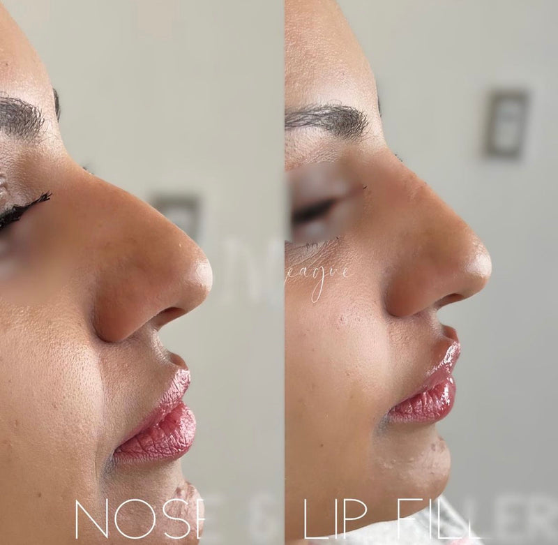 Before and after non surgical rhinoplasty Vancouver dermal filler results