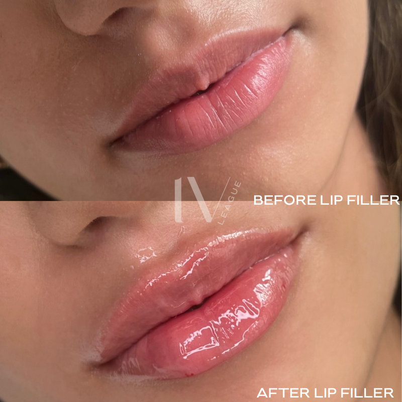 natural lip filler results vancouver six clinic vicki nguyen rn