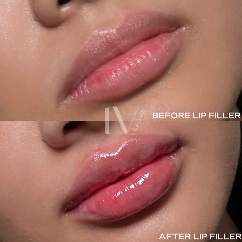 natural lip filler enhancement vancouver six clinic