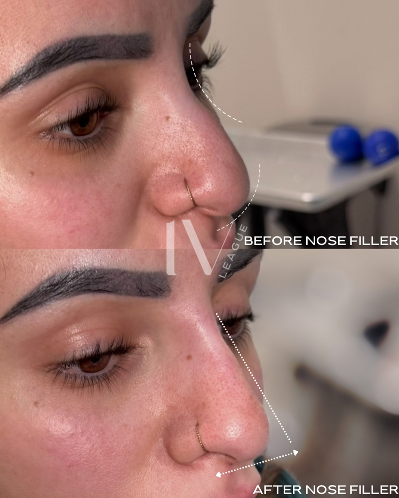 Liquid rhinoplasty nose bridge enhancement Vancouver BC