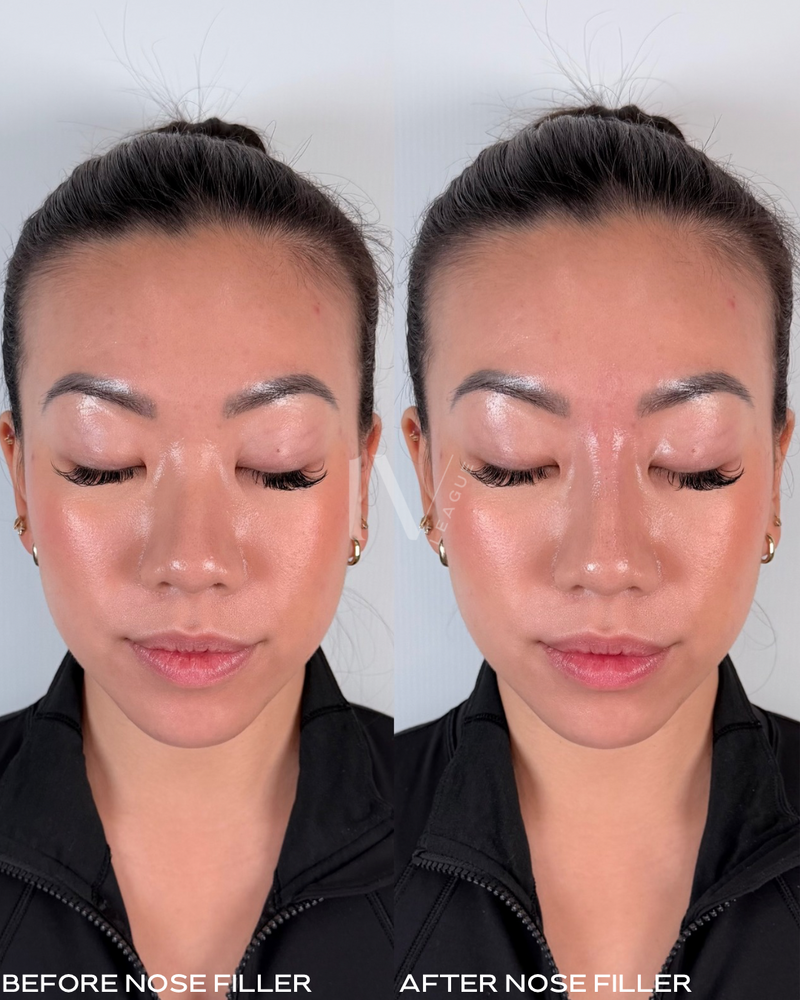 Nose bridge filler treatment Vancouver at IV League Injections