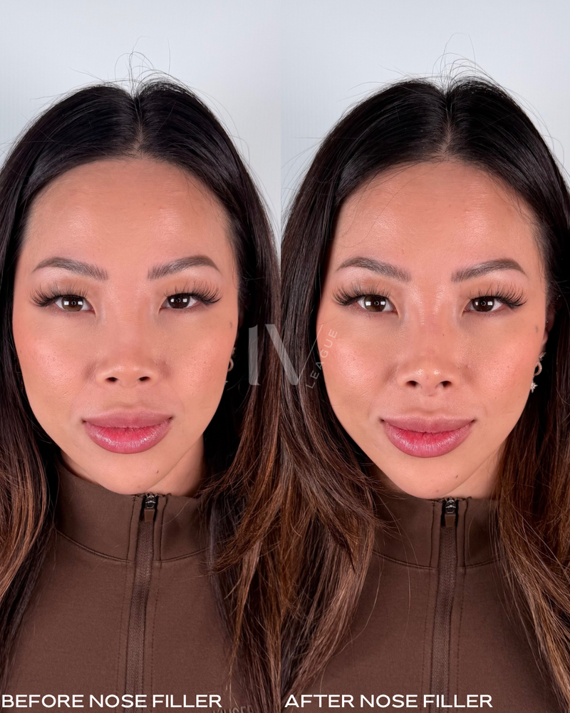 Before and after nose filler Vancouver smoothing dorsal hump with dermal filler