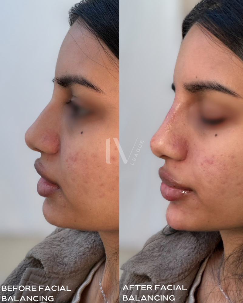 Precision dermal filler placement for natural nose contouring.