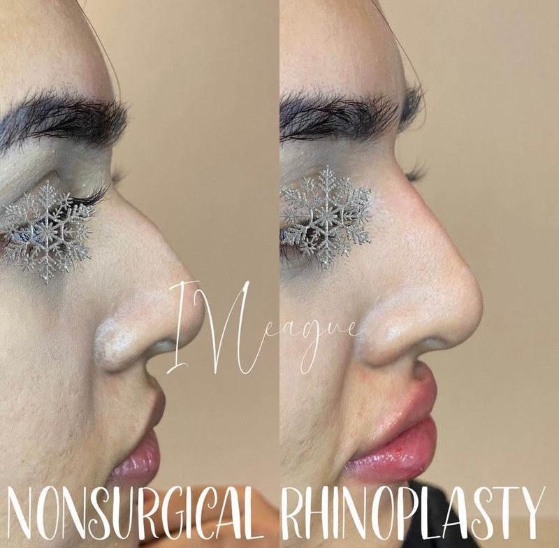 Non surgical rhinoplasty Vancouver cosmetic treatment