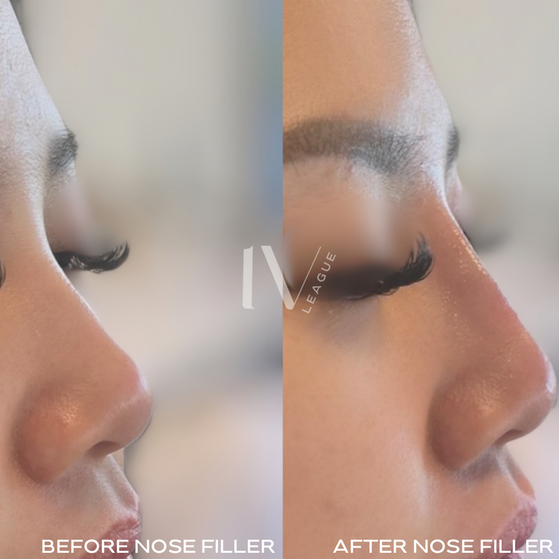 Nose filler Vancouver aesthetic treatment at Six Clinic Vancouver