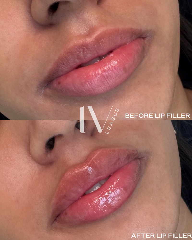 subtle lip filler vancouver dermal filler lips six clinic