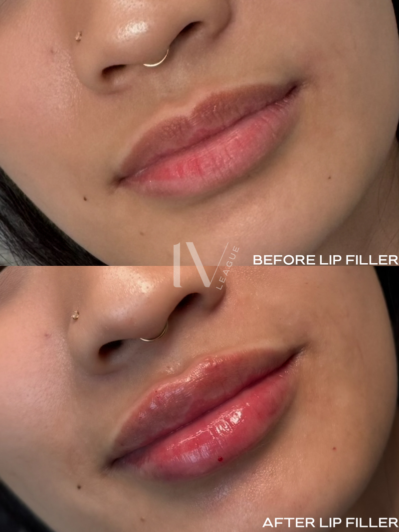 subtle lip filler results vancouver cosmetic injector