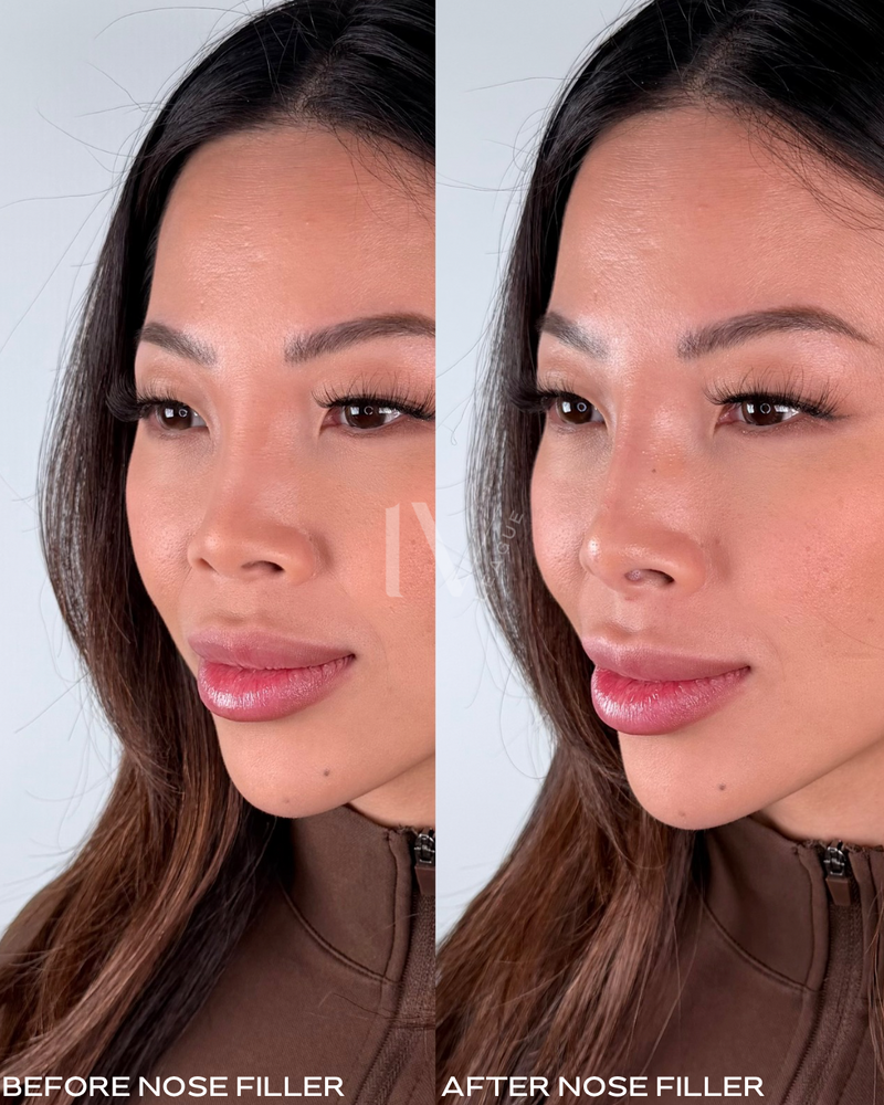 Liquid rhinoplasty Vancouver results by cosmetic injector Vicki Nguyen RN